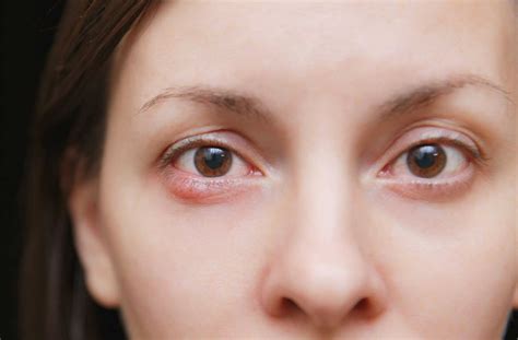 Dry Eyelids Causes