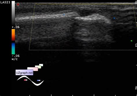 Soft Tissues Sonography Frontal Area Lesion Clinical Report Video Images Ultrasound