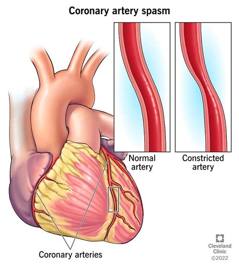 Coronary Artery Spasm: Causes, Symptoms And Treatment, 51% OFF