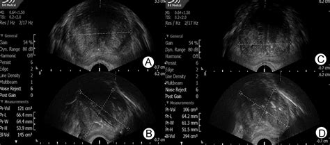 Prostatic Arterial Embolization Post Procedural Follow Up Techniques