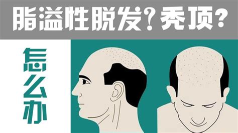 为什么脱发人群的年龄越来越小？年轻人脱发还有救吗？ 知乎