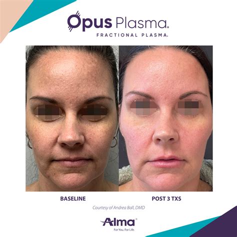 Opus Plasma Before And After 16 Renew Wellness And Aesthetics