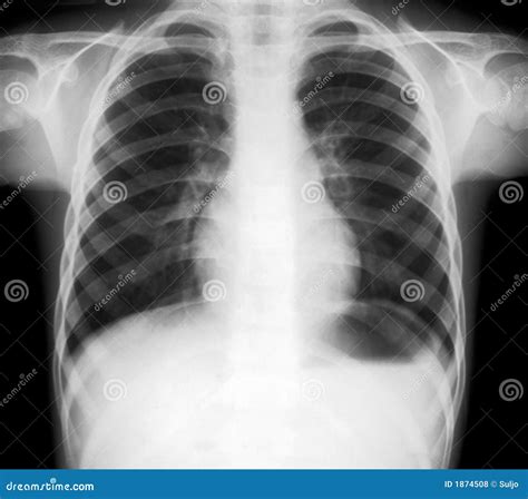 X-ray Of Lungs Royalty Free Stock Photos - Image: 1874508