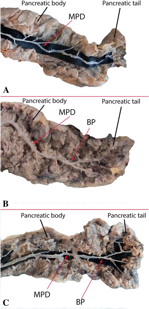 Ductal Anomalies At The Level Of The Pancreatic Tail A—did Not Divide Download Scientific