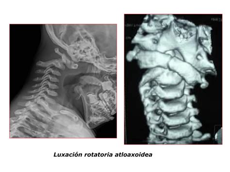 Lesiones Cervicales Sindrome De Latigazo Pdf