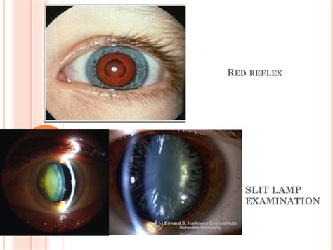 Ppt Cataract Powerpoint Presentation Free Download Id 9336876