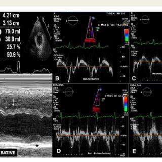 A A Preoperative M Mode Recording At Mid Ventricular Level Is Shown