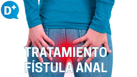 Diagnóstico Y Tratamiento De La Fístula Anal Youtube