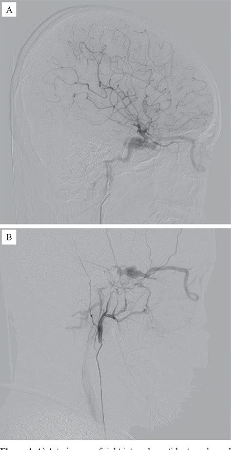 Figure From Endovascular Treatment With Transvenous Approach For