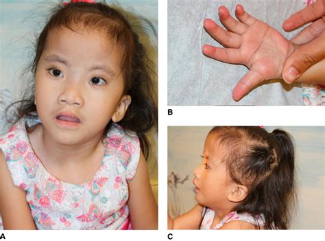 Facial Defects As Major Feature Clinical Tree