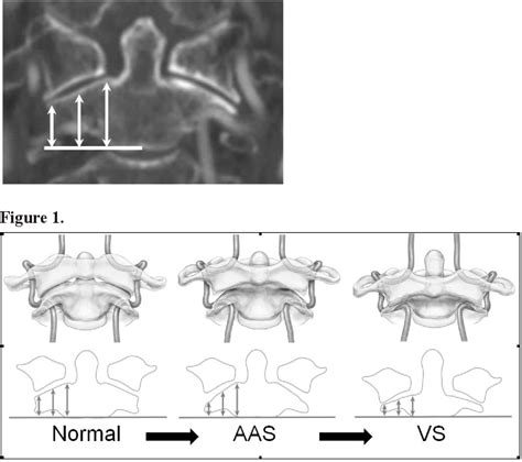 Figure 1 From Analysis Of Development Of High Riding Vertebral Artery