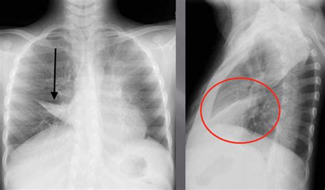 Condition Specific Radiology Atelectasis Stepwards