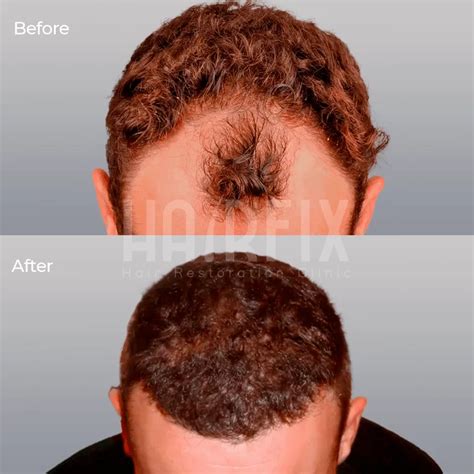 Hair Transplant Price In Tijuana Mexico Hairfix