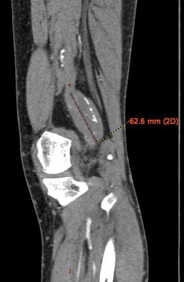 Popliteal arterial aneurysm | pacs