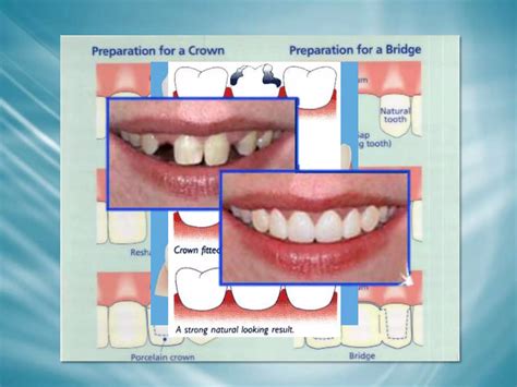 Crowns And Bridges Ppt