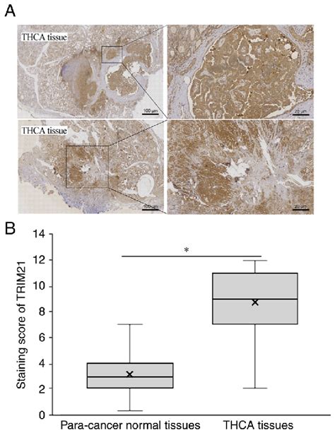 Expression Of Trim21 In Thca A Ihc Staining Of Trim21 In Thca And