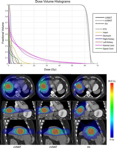 Top Dose Volume Histograms For A Typical Liver Sbrt Case Bottom Dose