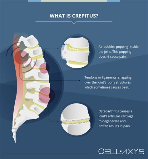 Causes Of Popping Noise In The Lower Back Cellaxys