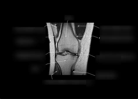 Mri Knee Coronal 5 Diagram Quizlet