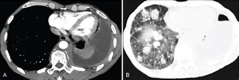 Axial Ct Of The Thorax A Mediastinum Window Showing Retraction Of The Download Scientific