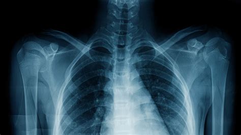 An Ai Used Medical Notes To Teach Itself To Spot Disease On Chest X