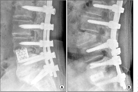 Figure From Loss Of Sagittal Balance And Clinical Outcomes Following