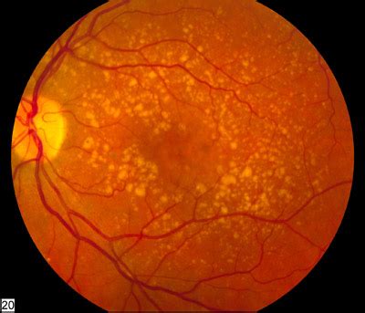 The Difference Between Wet And Dry Macular Degeneration Magruder Eye