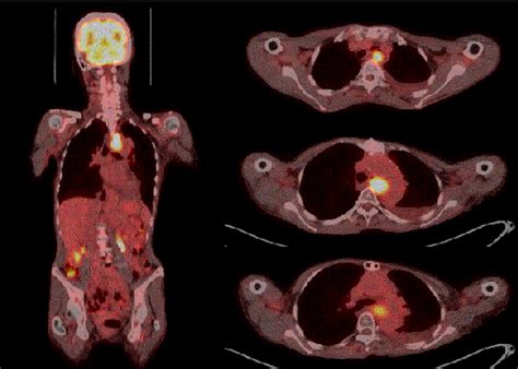 Figure From Radiation Induced Esophageal Leiomyosarcoma Years