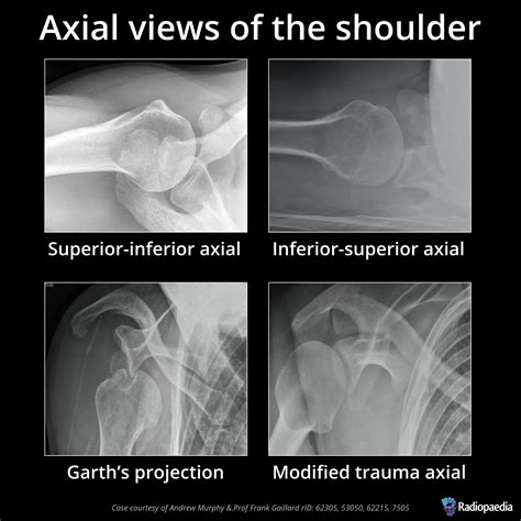 Shoulder X Ray Series At Dollie Martinson Blog