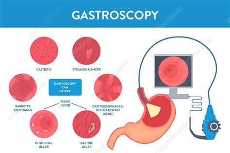 Gastroscopy Conceptual Illustration Stock Image F0342763 Science Photo Library