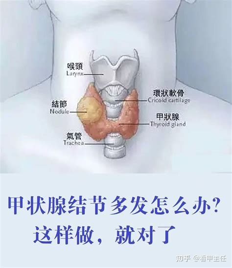 甲状腺结节多发怎么办？这样做，就对了 知乎