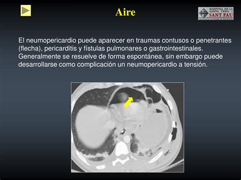 PPT Taponamiento cardíaco Causas y hallazgos radiológicos PowerPoint