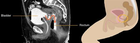 Abdominal CT Cystogram LITFL Radiology Library