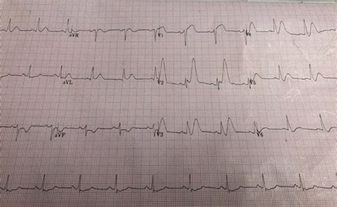 deWinters ECG - REBEL EM - Emergency Medicine Blog