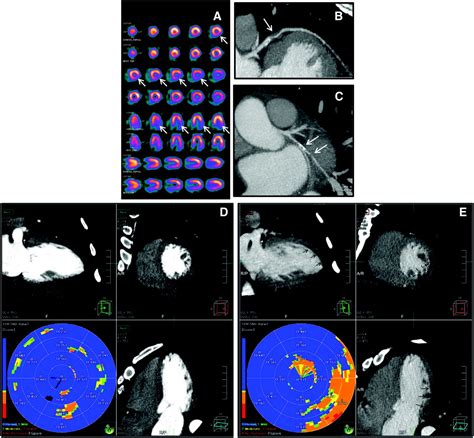 Computed Tomography Myocardial Perfusion Imaging With Row Detector