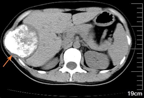 Frontiers Case Report Cavernous Hemangioma Of Rib An Extremely Rare Venous Malformation But