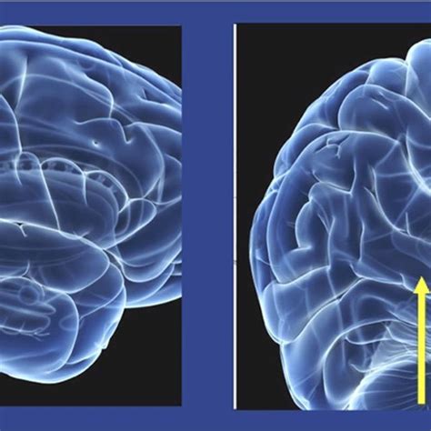 Is that a Headache or a Brain Aneurysm? #BrainAneurysms #health # ...