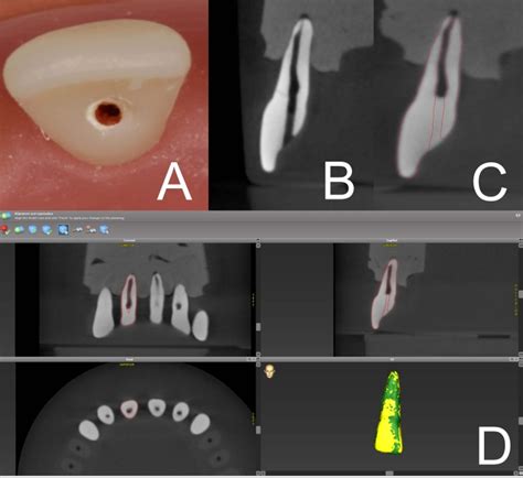 Dynamic Navigation In Endodontics Guided Access Cavity Preparation By Means Of A Miniaturized