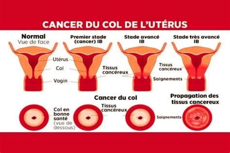 LE CANCER DU COL DE LUTERUS Laboratoires S3P