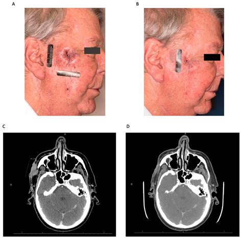 Neoadjuvant Immunotherapy For Cutaneous Squamous Cell Carcinoma