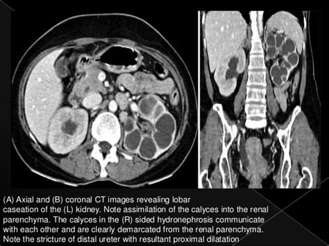 Renal tuberculosis radiology