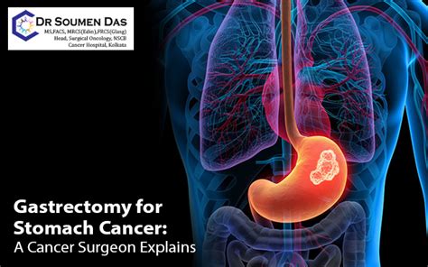 Gastrectomy For Stomach Cancer A Cancer Surgeon Explains