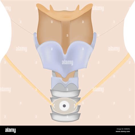 Cánula de traqueostomía Fotografía de stock Alamy