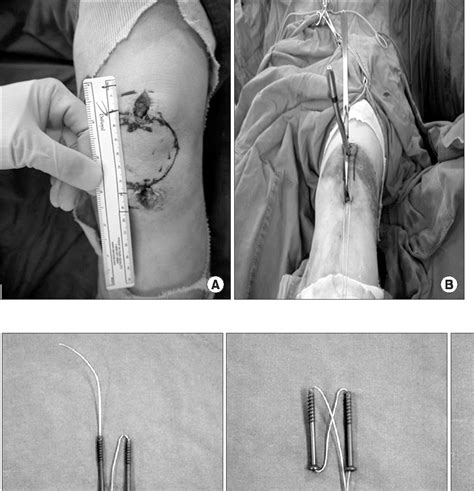 Figure 1 From Percutaneous Cannulated Screws With Tension Band Wiring