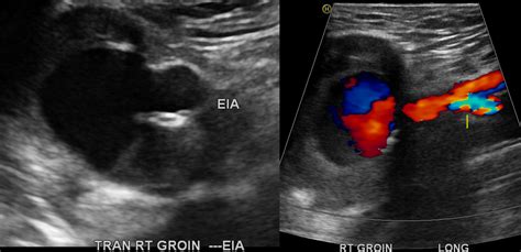 Pulsatile Groin Mass 15 Years After An Aorto Bifemoral Bypass Graft Michael Cumming Md Mba