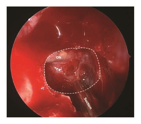 Top View Of Onodi Cell White Dashed Line Showed Dehiscence Of The