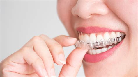 What Are Invisalign Braces And How Are They Used