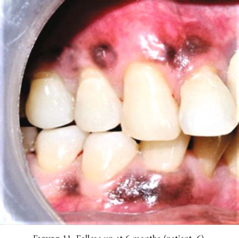 Figure From Marine Collagen Matrix Carrier With Injectable Platelet