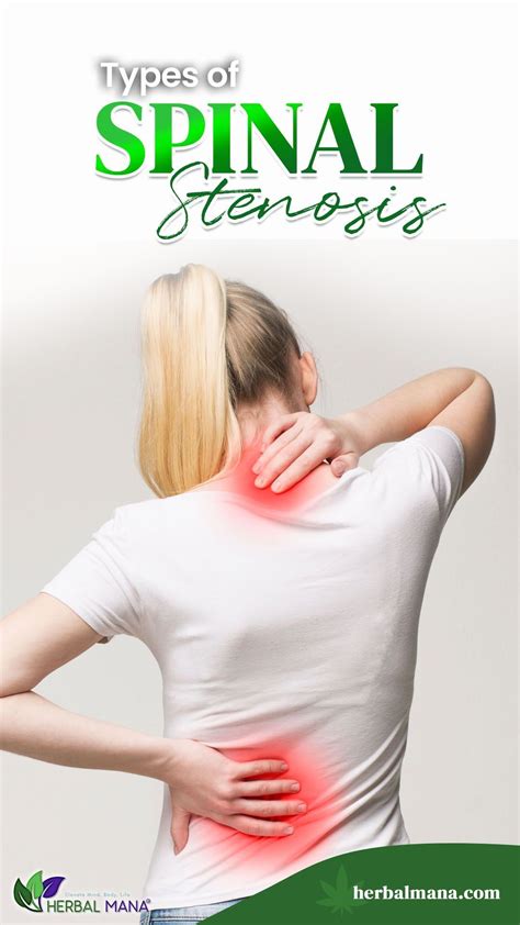 Cervical Spinal Canal Stenosis Artofit