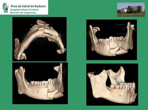 Fractura De Mandibula Dr Juanjo Arroyo Ppt Descarga Gratuita